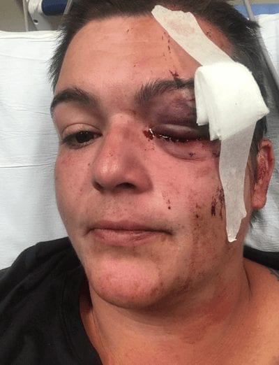 Photog Linda Tirado’s injuries Minneapolis police shot her left eye with a rubber bullet.