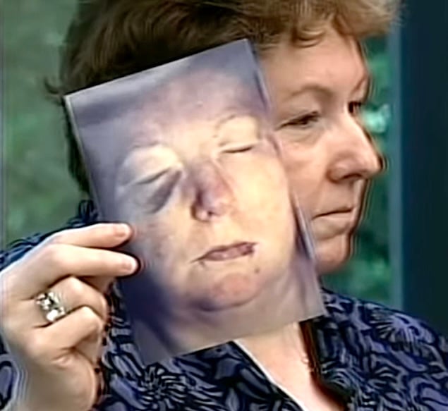 Survivor Susan Kuhnhausen shows her injuries